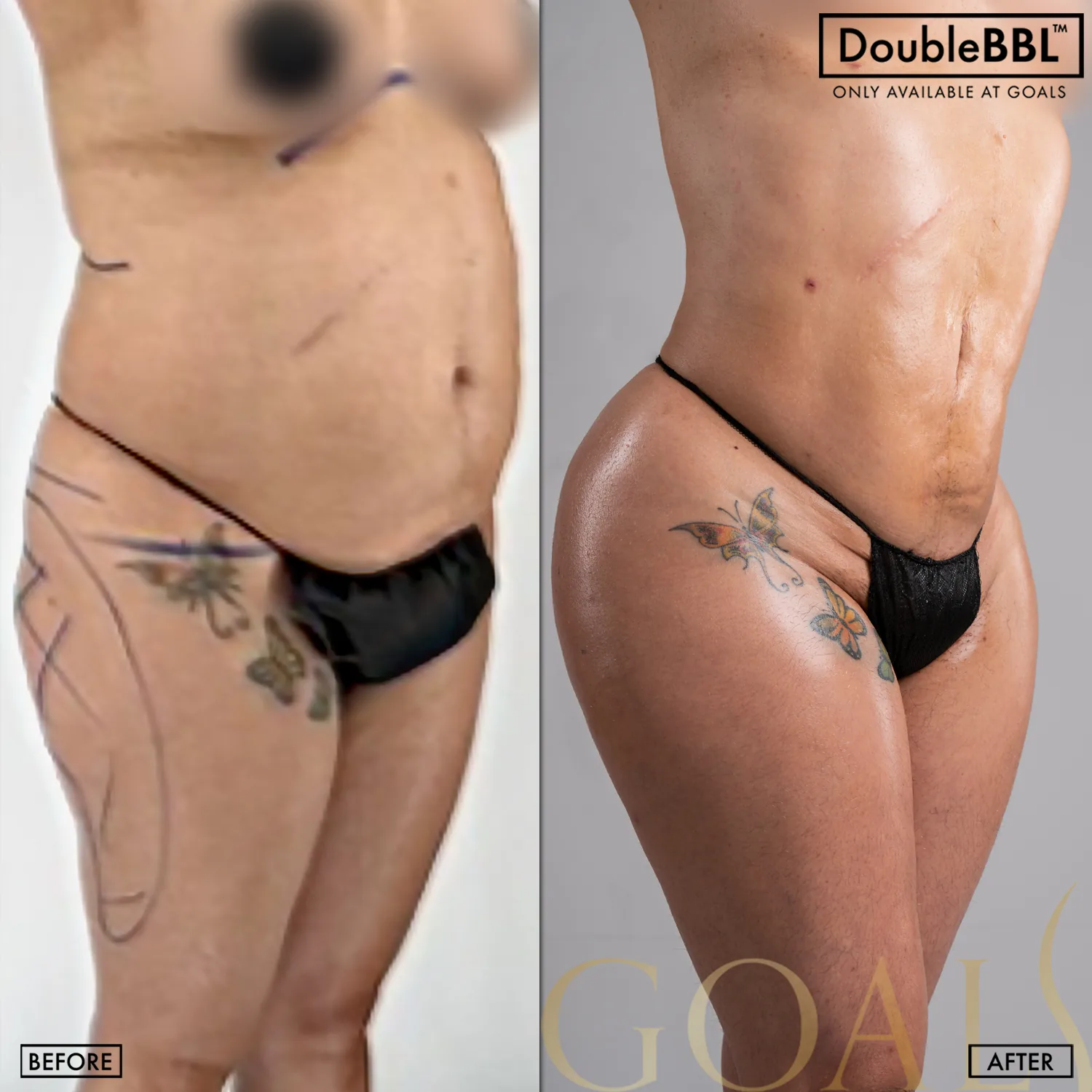 Before and after — Los Angeles, patient 3