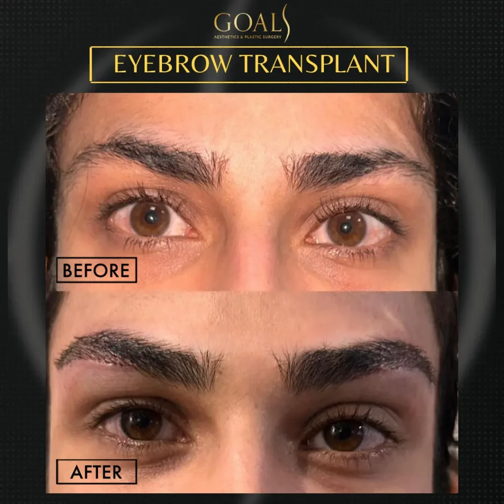 Before and after — Trasplante de Cejas · Central Park, patient 2