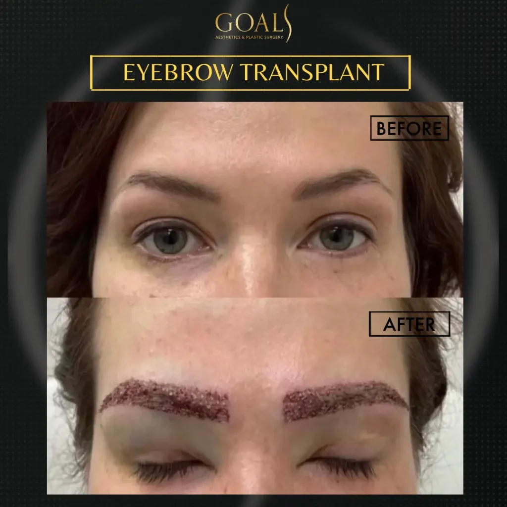 Before and after — Trasplante de Cejas · Central Park, patient 5