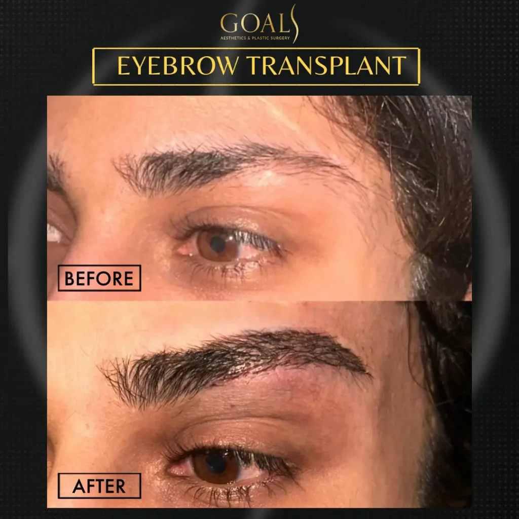 Before and after — Trasplante de Cejas · Central Park, patient 6