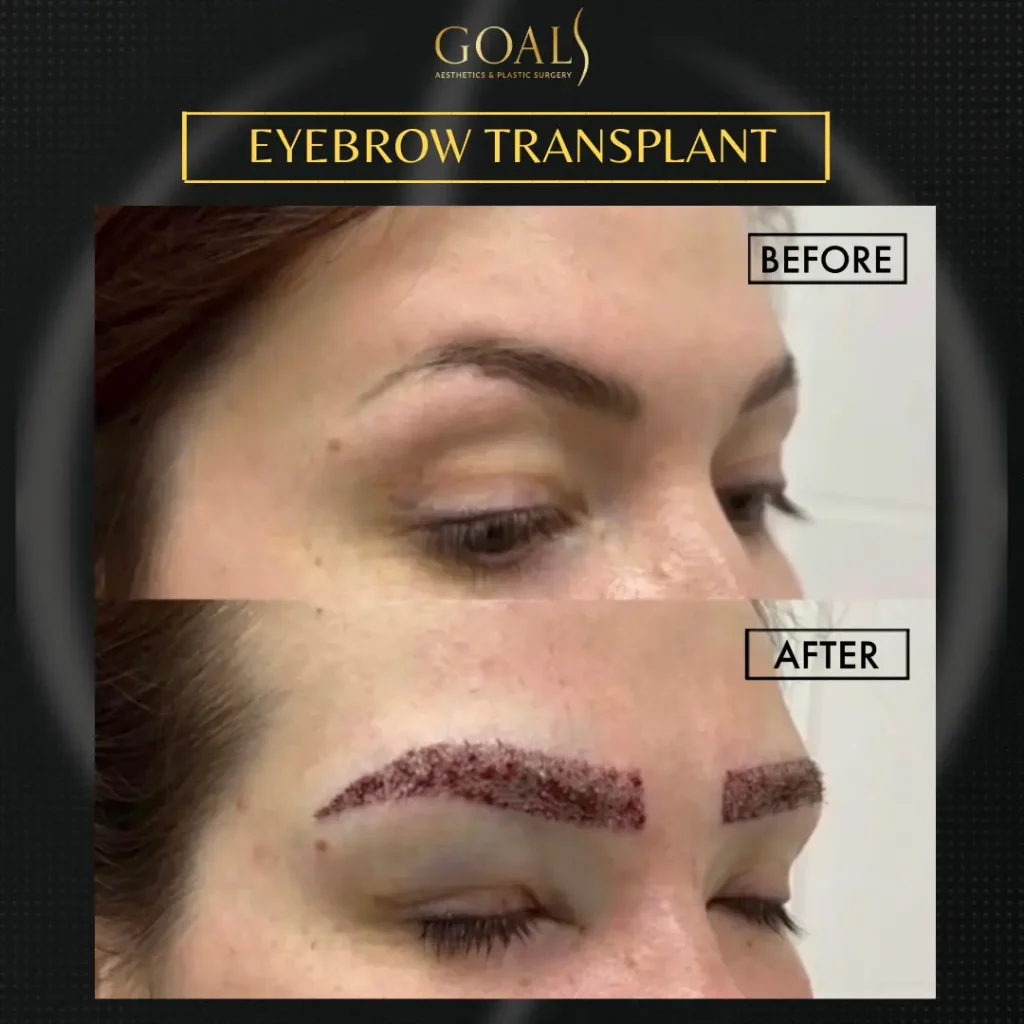 Eyebrow Hair Transplant — patient result