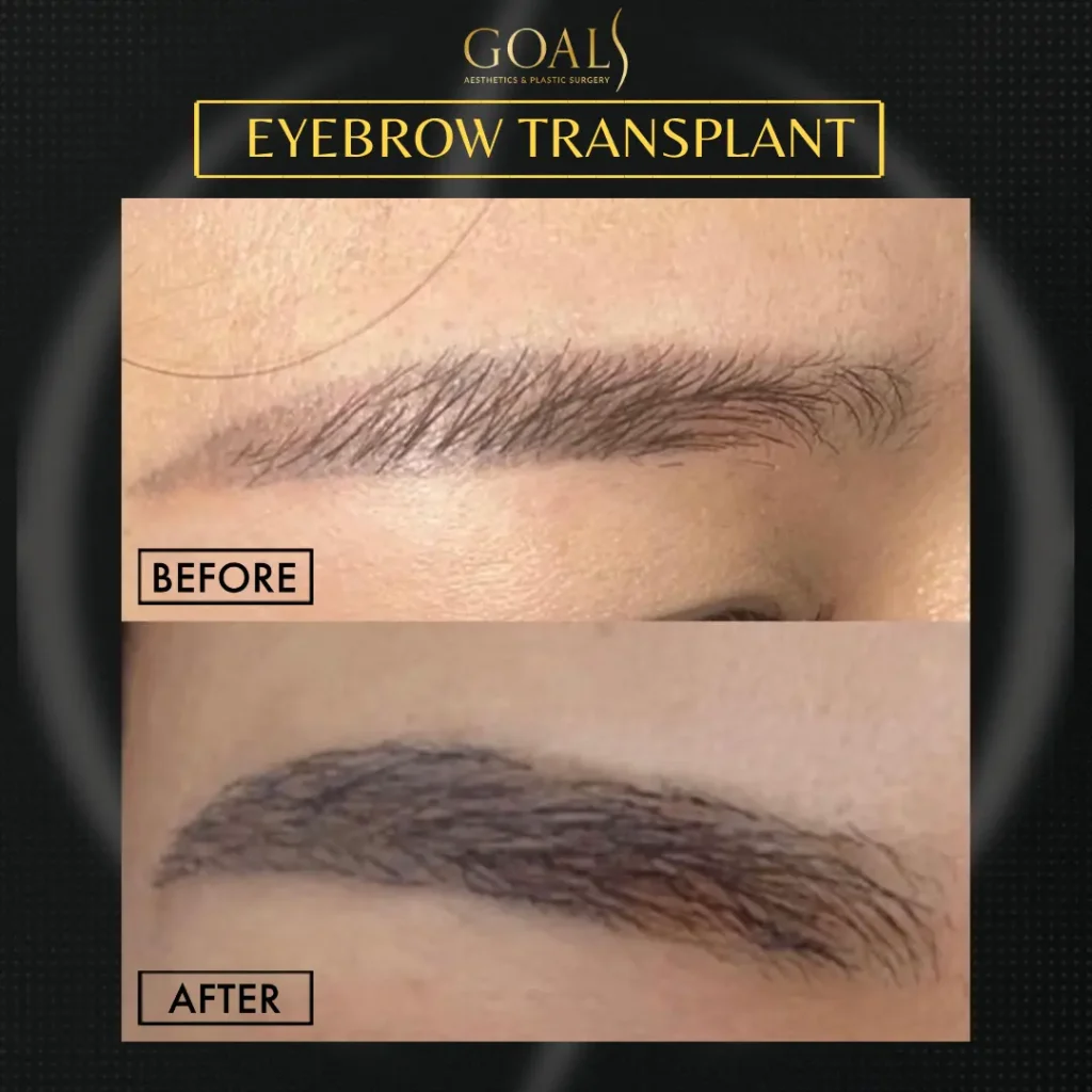 Before and after — Eyebrow Hair Transplant, patient 1