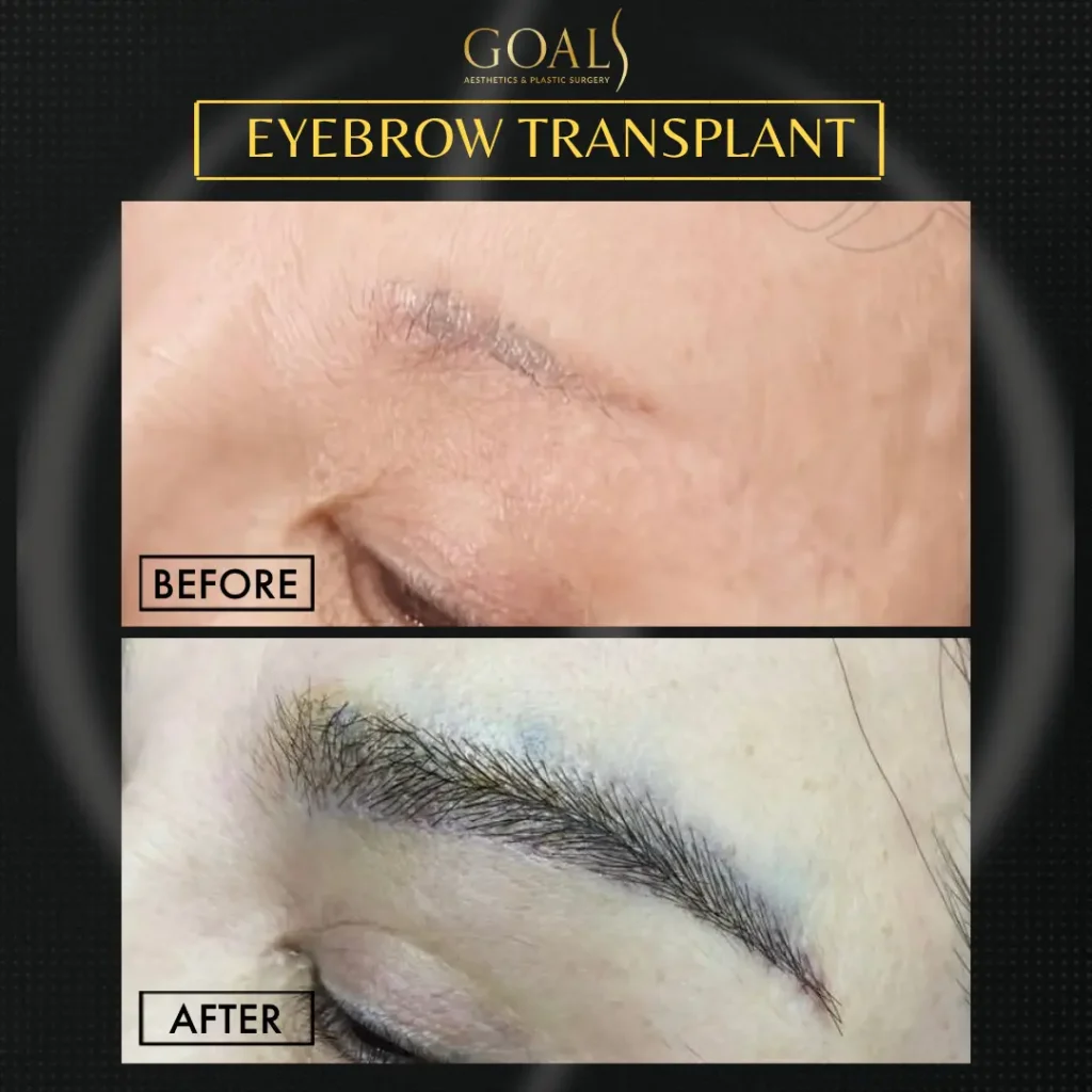 Before and after — Eyebrow Hair Transplant, patient 2