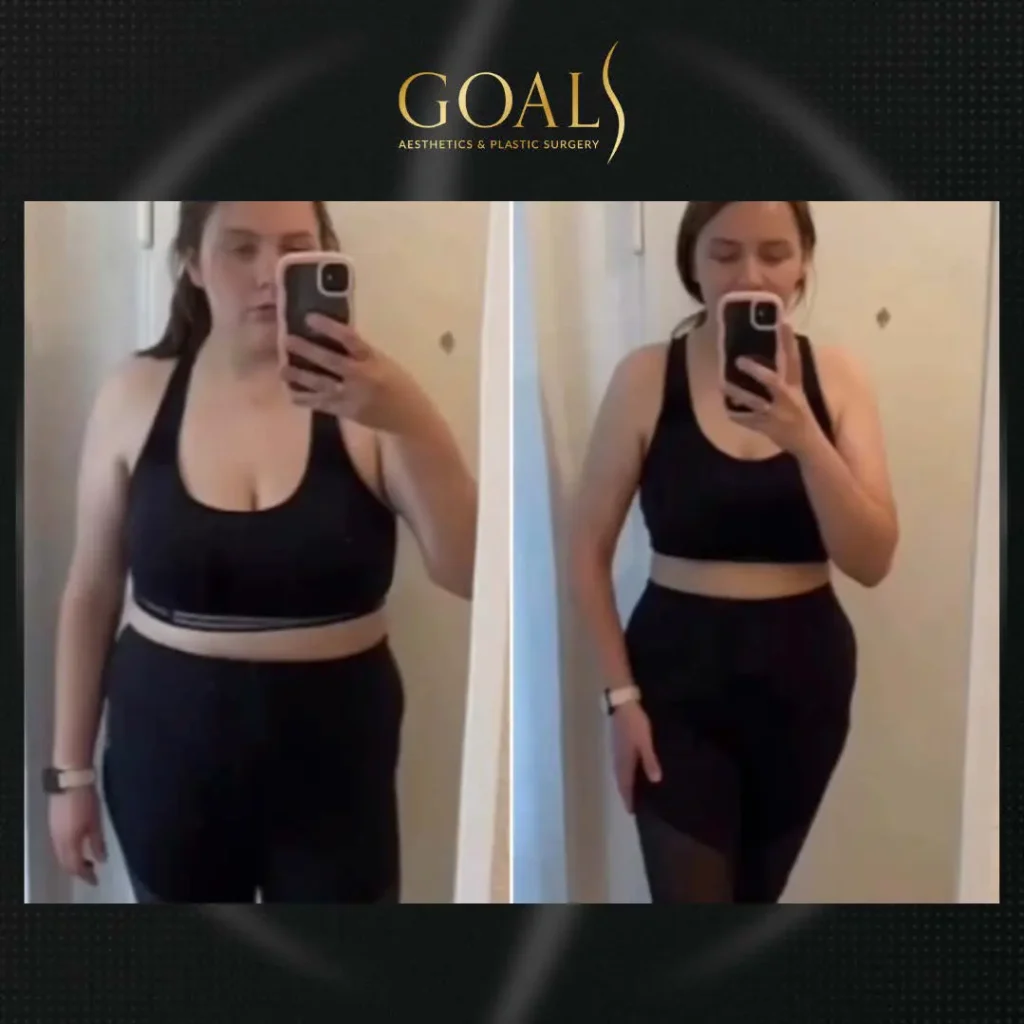 Fat Loss Shots — patient result
