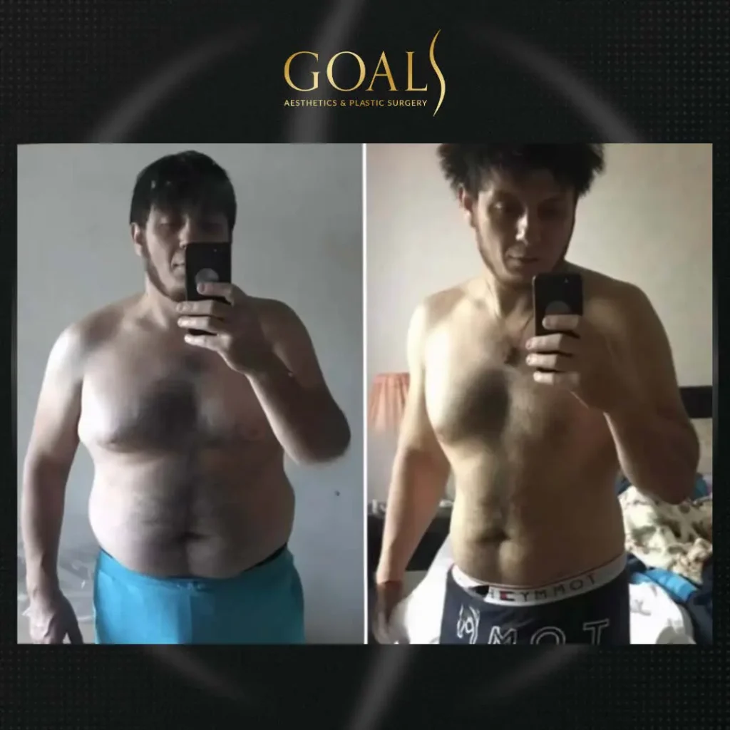 Before and after — Fat Loss Shots · Bronx, patient 1