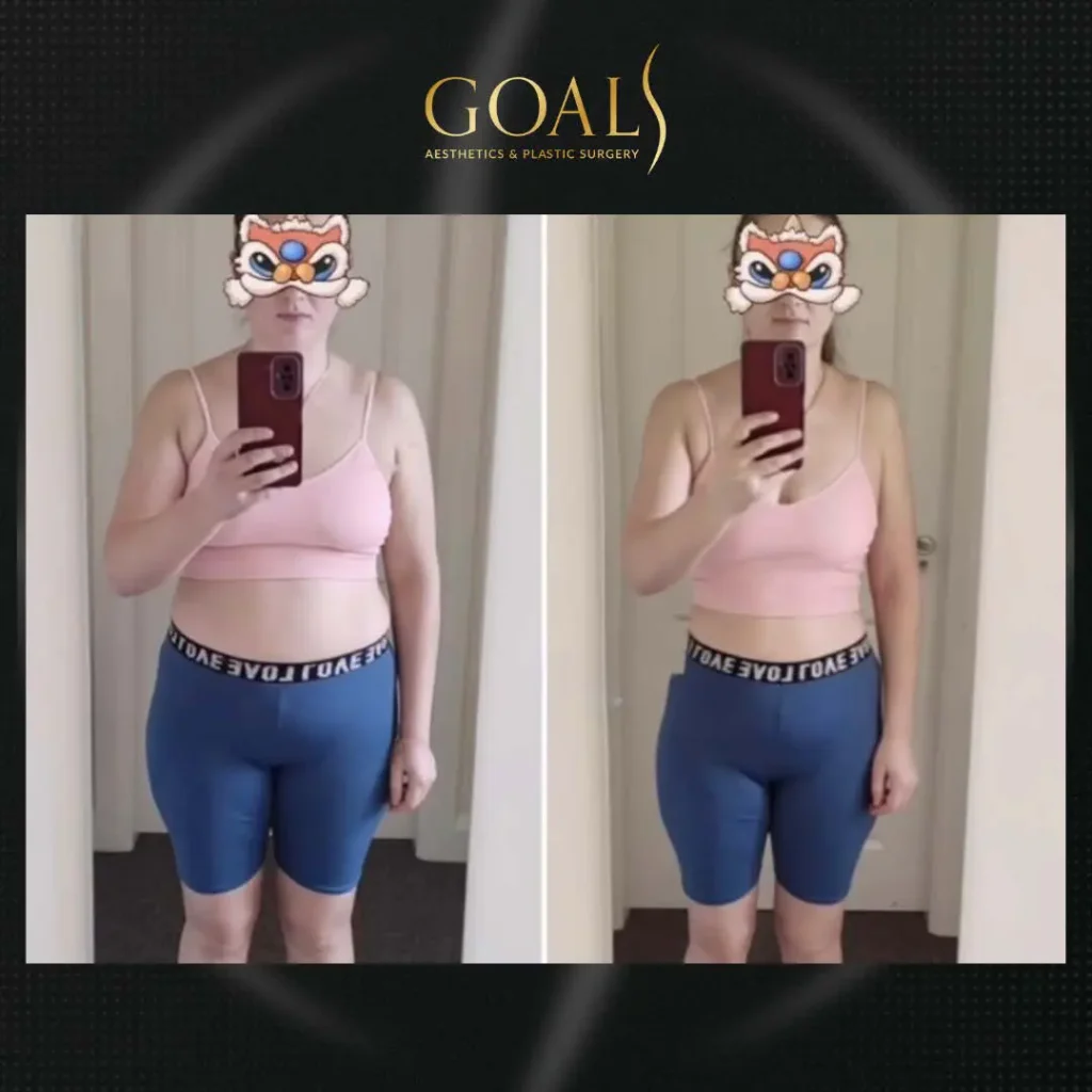 Before and after — Fat Loss Shots · Bronx, patient 2