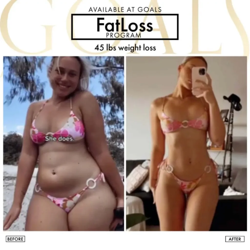 Before and after — Fat Loss Shots · Bronx, patient 3
