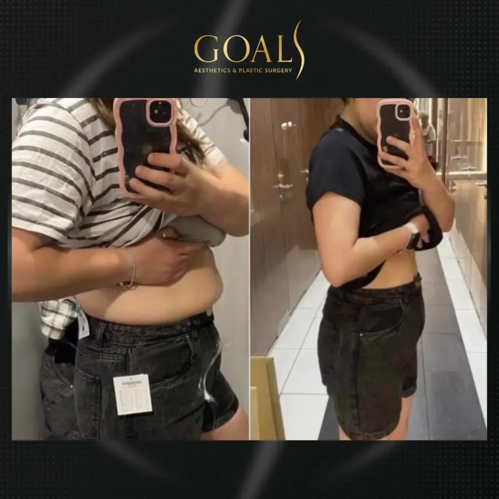 Before and after — Fat Loss Shots · Bronx, patient 4