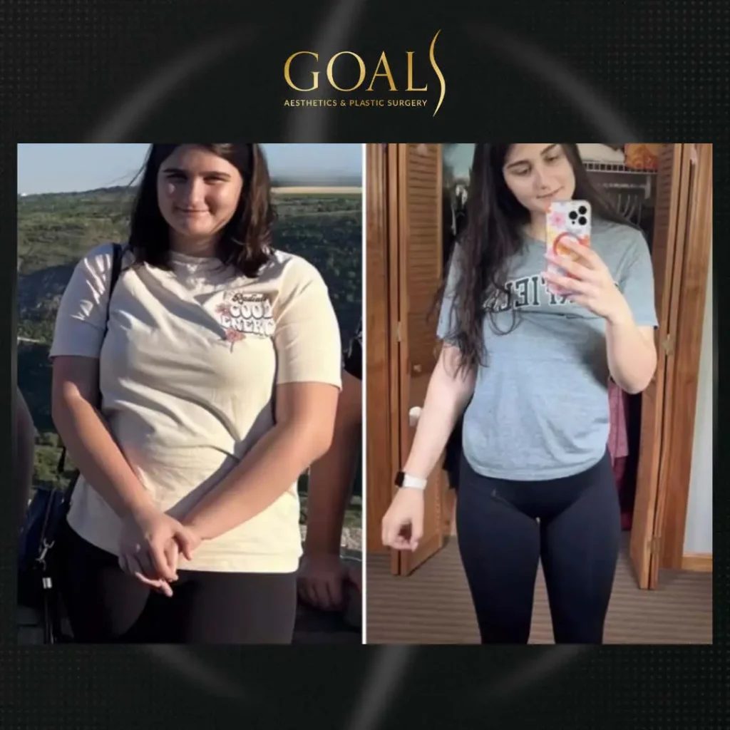 Before and after — Fat Loss Shots, patient 4
