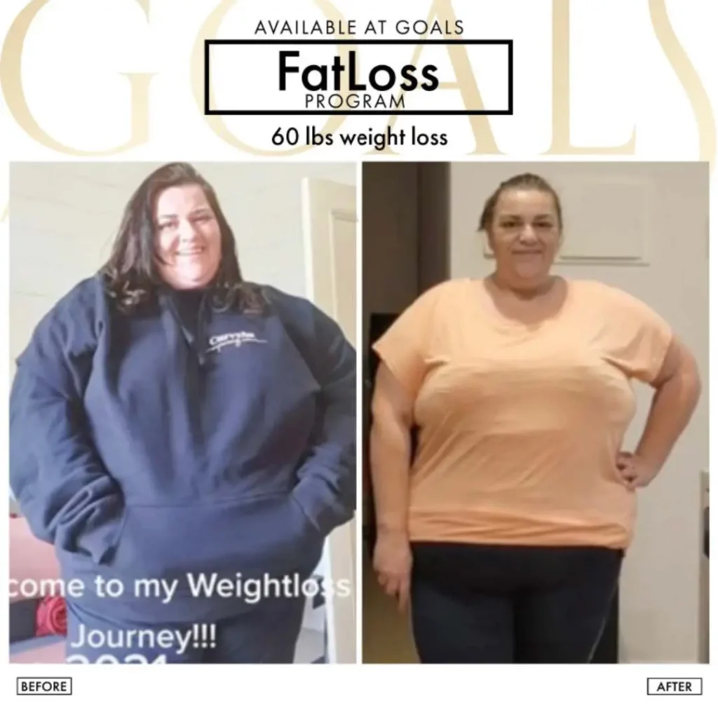 Before and after — Fat Loss Shots, patient 5