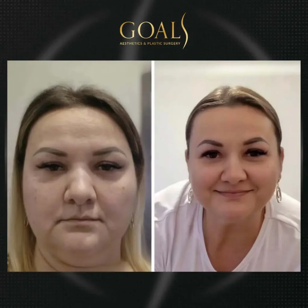 Before and after — Fat Loss Shots, patient 6