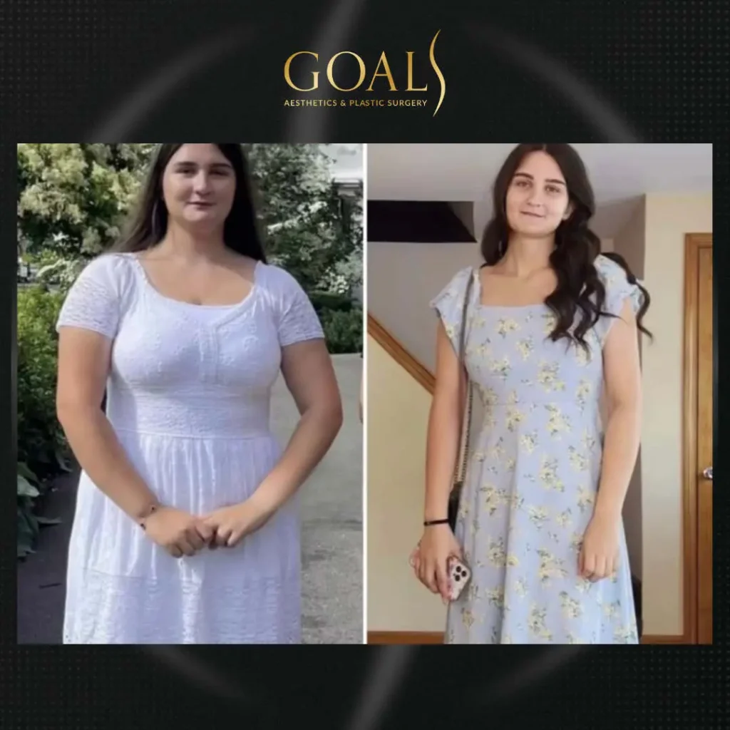 Before and after — Fat Loss Shots · Atlanta Walton St., patient 1
