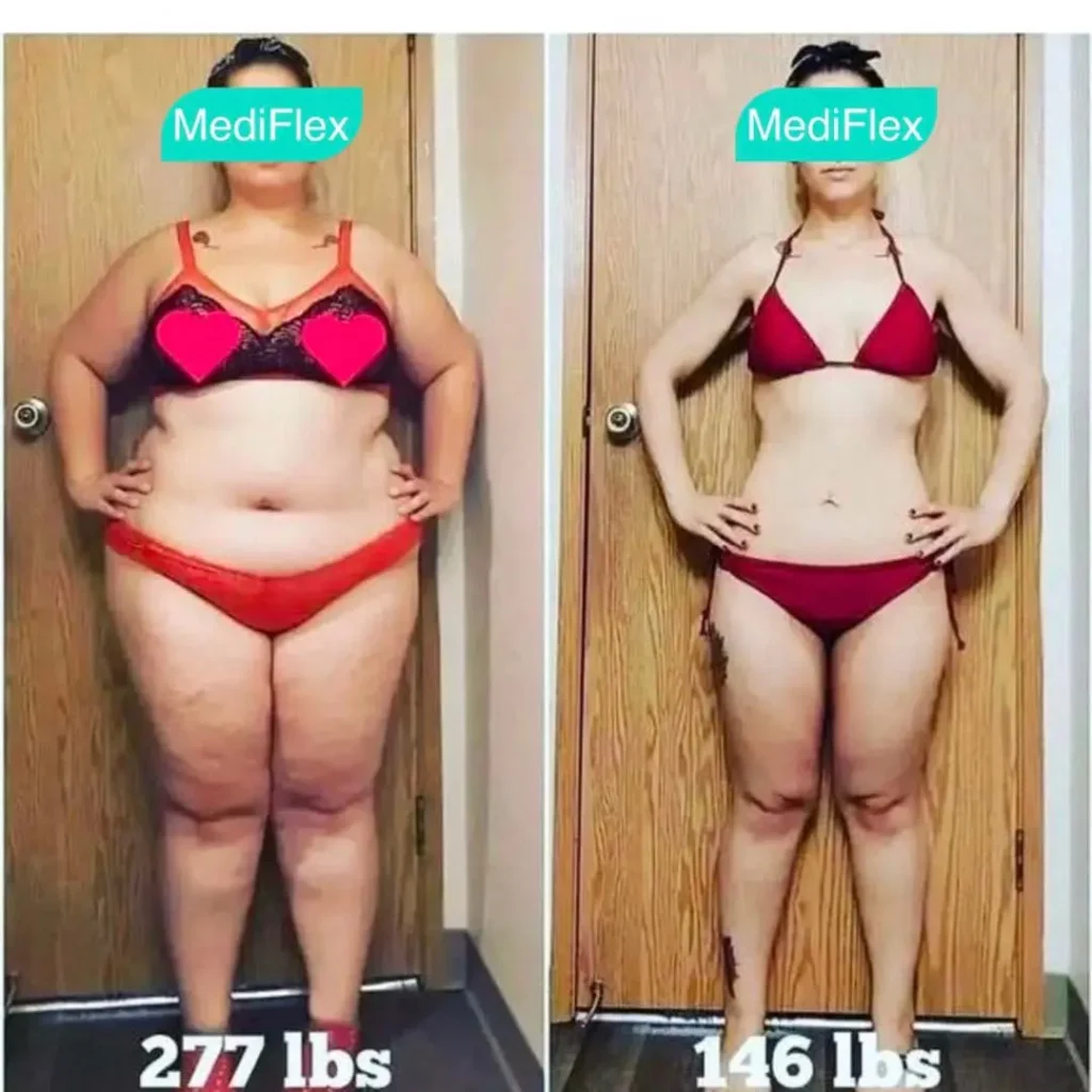 Before and after — Fat Loss Shots, patient 1