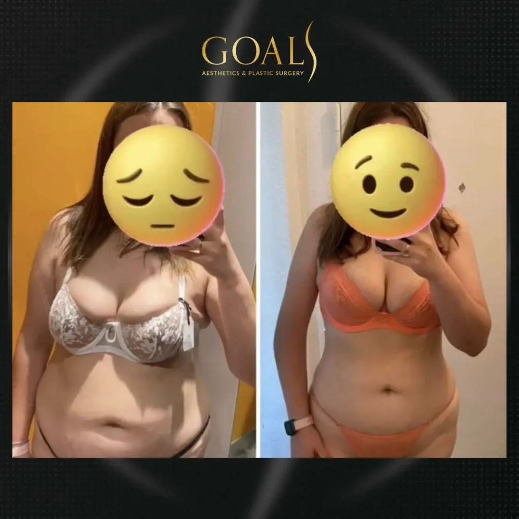 Before and after — Fat Loss Shots, patient 2