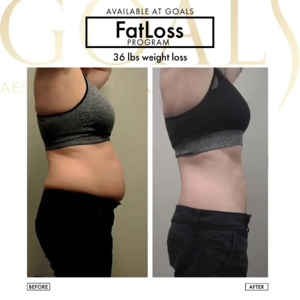 Before and after — Fat Loss Shots, patient 3