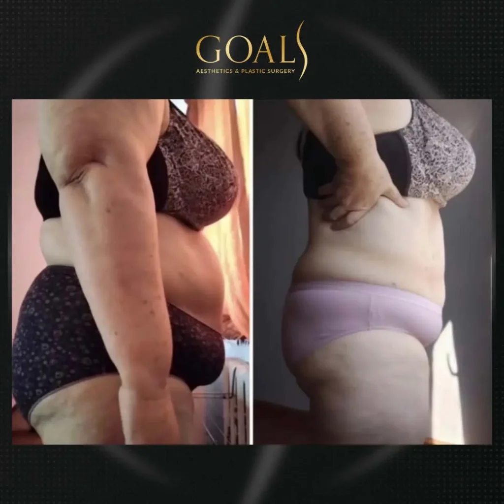 Before and after — Fat Loss Shots, patient 4