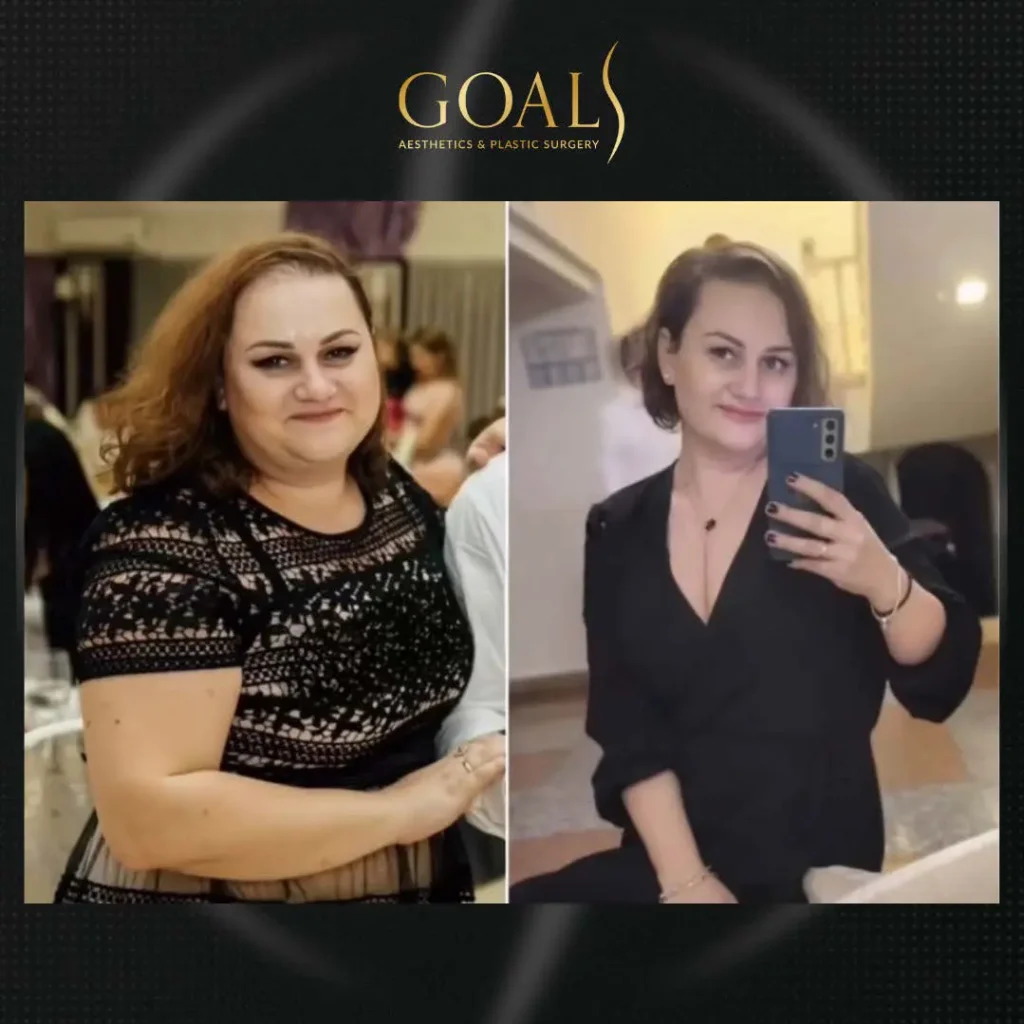 Before and after — Fat Loss Shots, patient 5