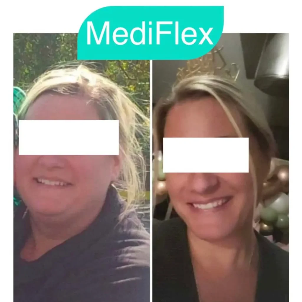 Before and after — Fat Loss Shots, patient 6