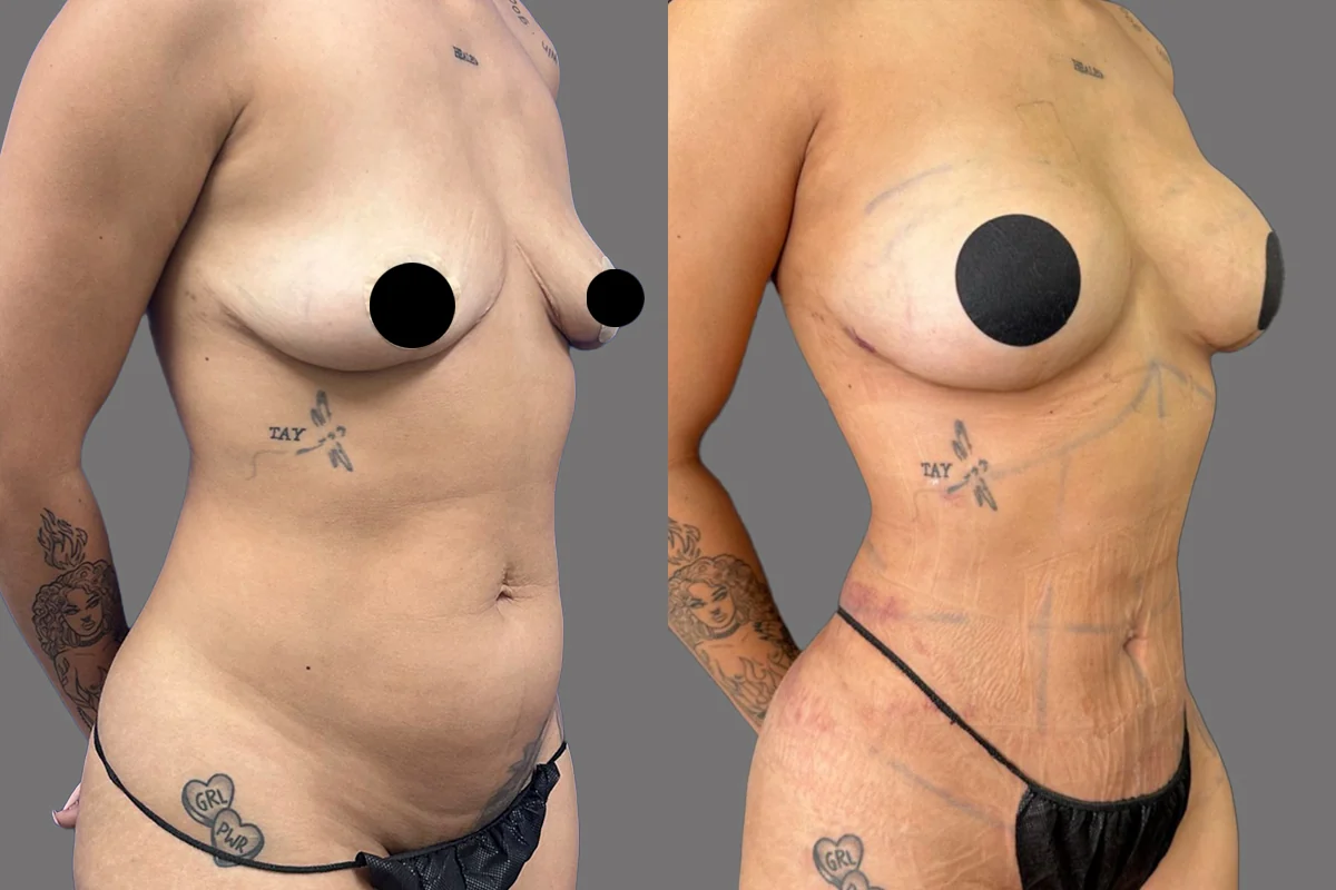 Before and after — Fat Transfer Breast Augmentation, patient 1