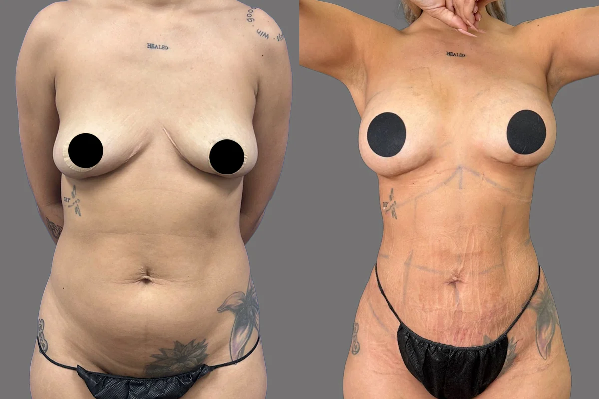 Before and after — Fat Transfer Breast Augmentation, patient 2