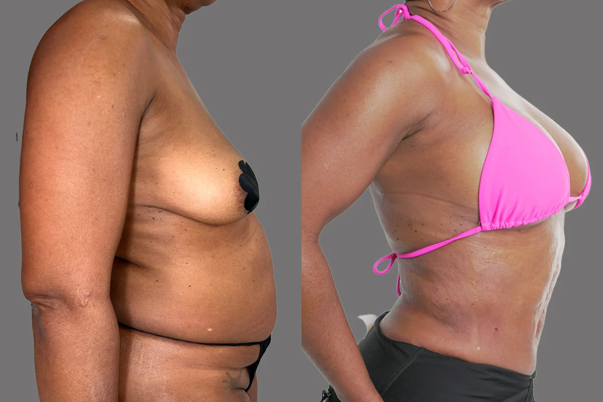 Before and after — Fat Transfer Breast Augmentation, patient 3