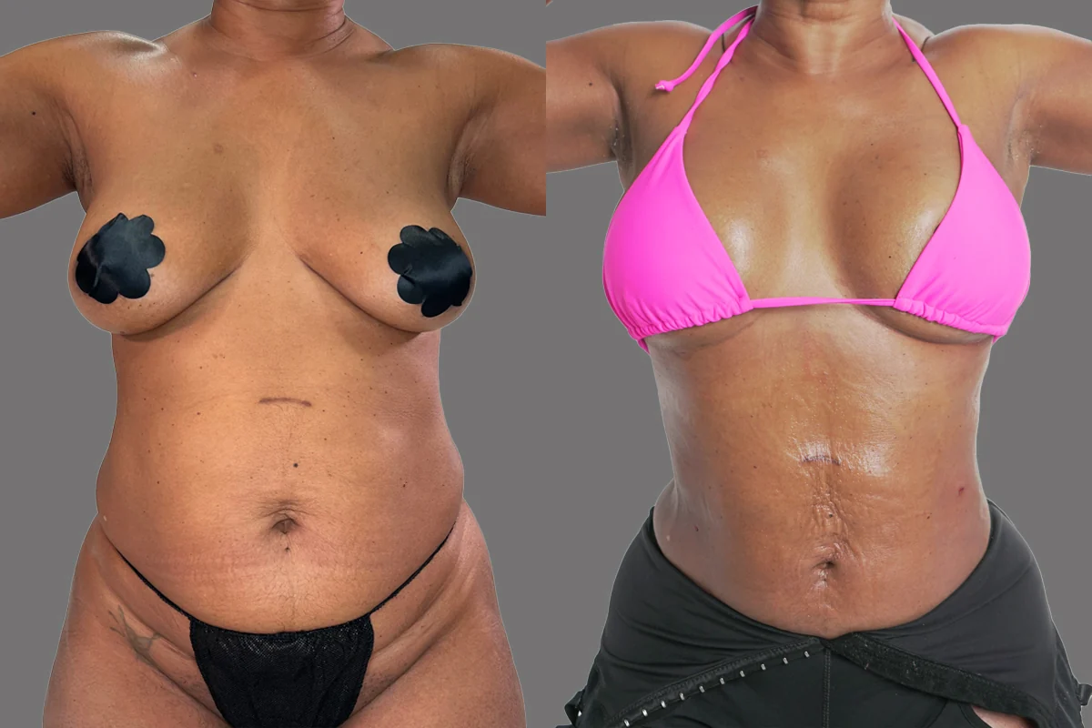 Before and after — Fat Transfer Breast Augmentation, patient 4