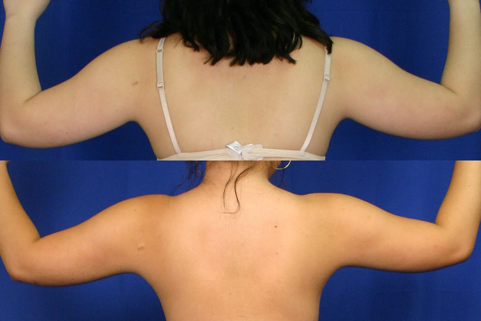 Antes y después de Lipoescultura Despierta con FlexSculpt, IMC inicial 20-25