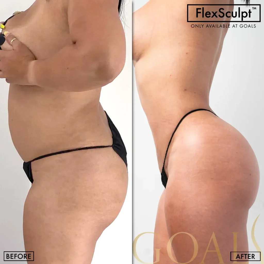 Antes y después de Lipoescultura Despierta con FlexSculpt, IMC inicial 20-25