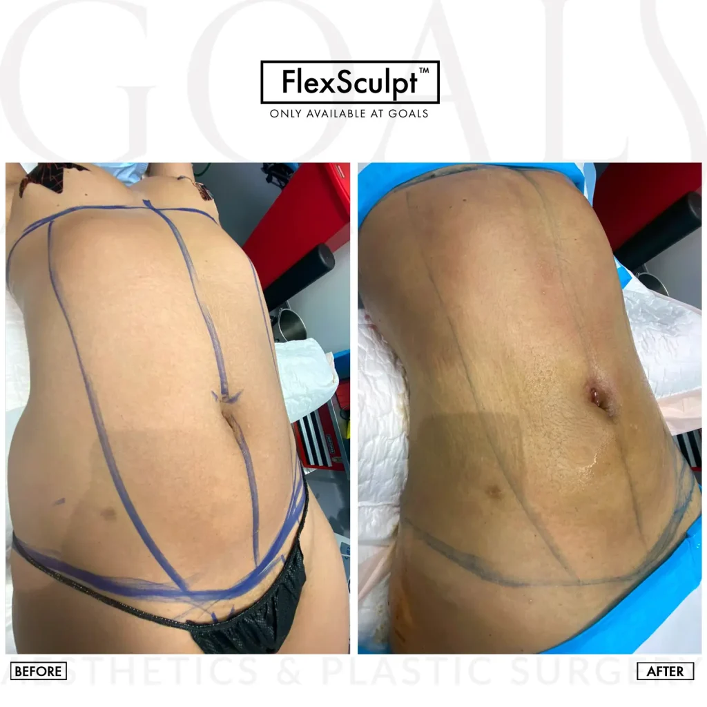 Before and after — Lipoescultura Despierta con FlexSculpt · Gaithersburg, patient 1