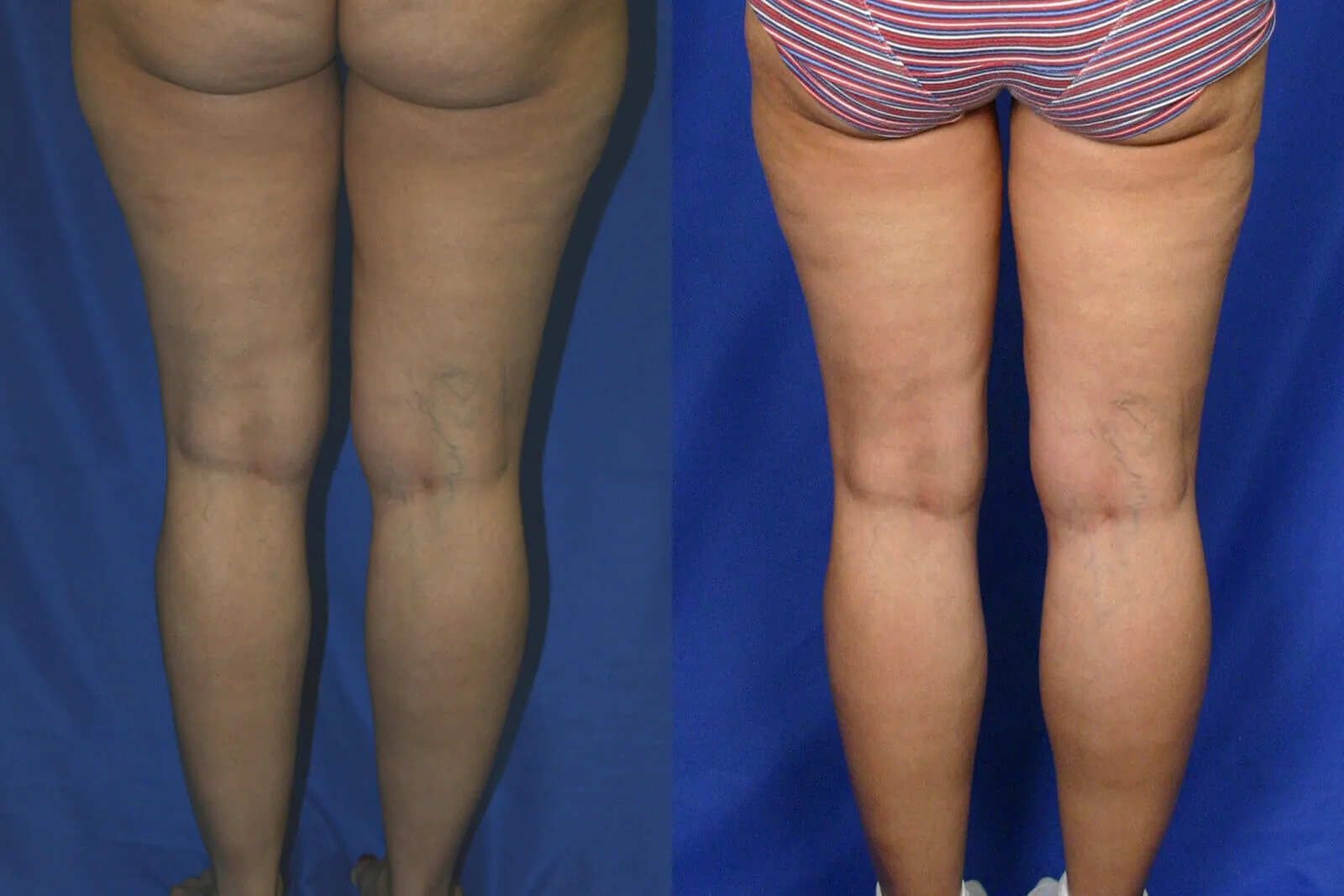 Before and after — Lipoescultura Despierta con FlexSculpt · Gaithersburg, patient 2
