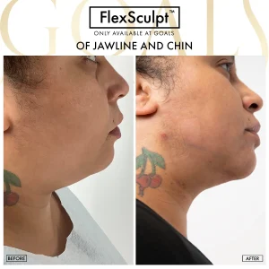 Before and after — Lipoescultura Despierta con FlexSculpt · Gaithersburg, patient 3