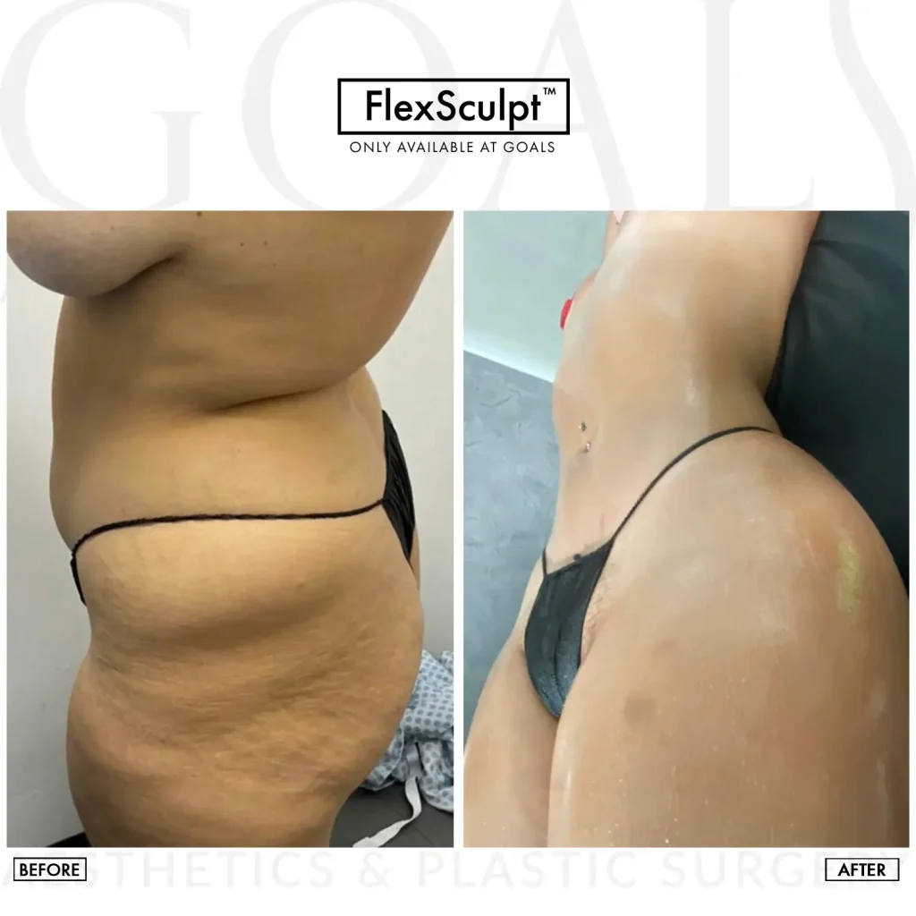 Before and after — Lipoescultura Despierta con FlexSculpt · Gaithersburg, patient 4
