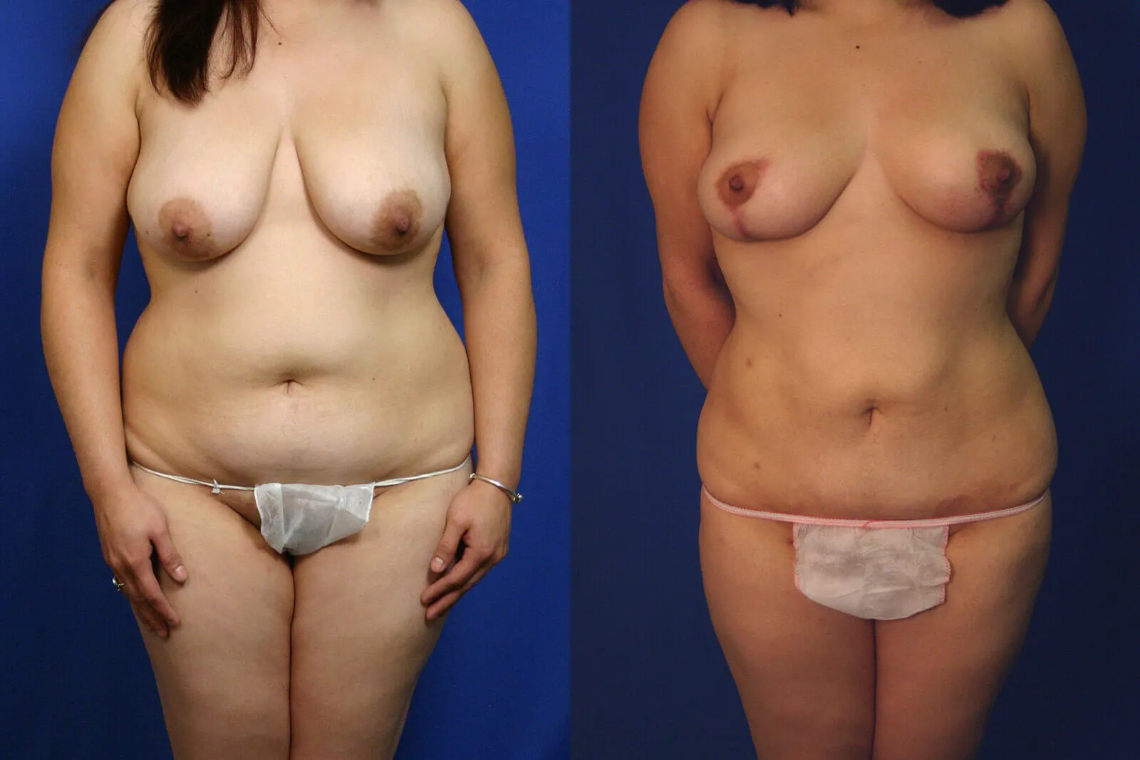 Before and after — Lipoescultura Despierta con FlexSculpt · Gaithersburg, patient 5