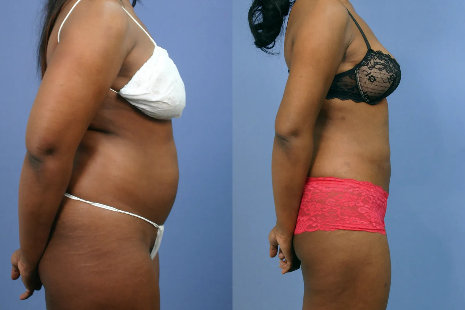 Before and after — Lipoescultura Despierta con FlexSculpt · Gaithersburg, patient 6