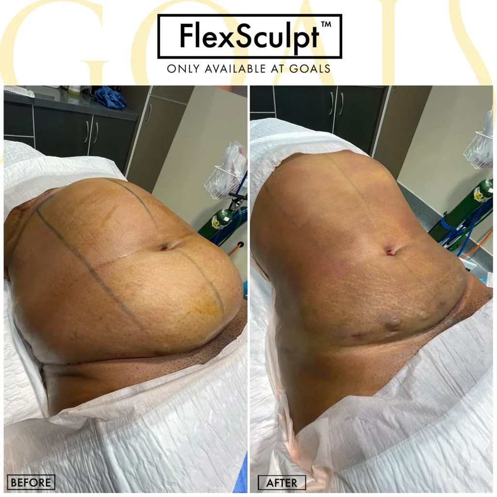 A Goals patient's awake liposuction result