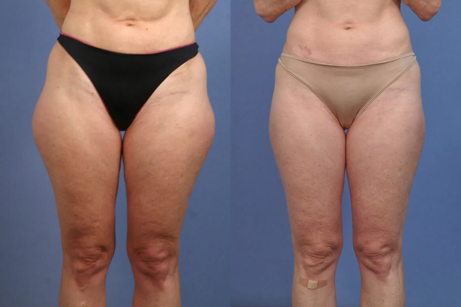 Before and after — Los Angeles, patient 6