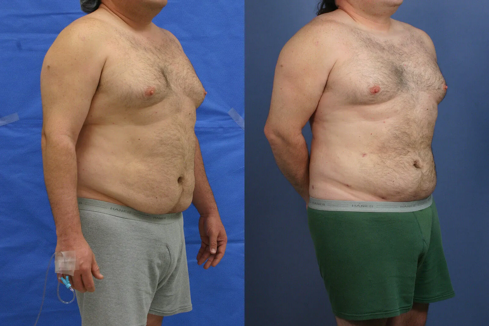 Before and after — Awake Liposuction with FlexSculpt · Los Angeles, patient 2