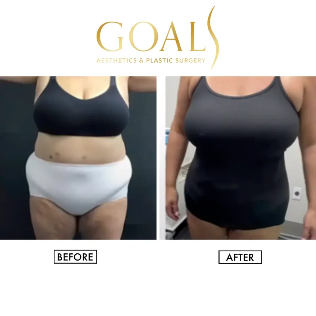 Awake Liposuction with FlexSculpt — patient result