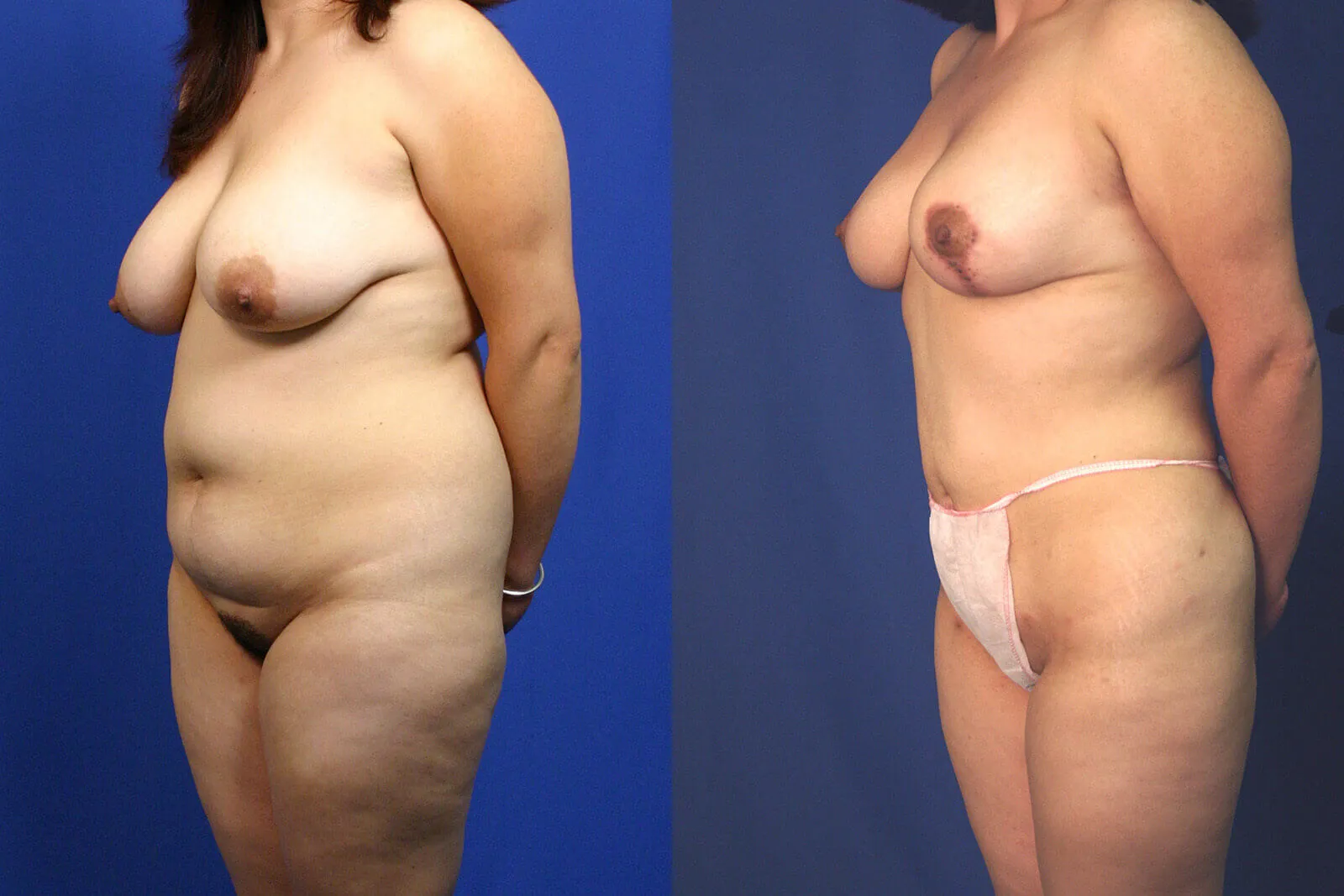 Before and after — Awake Liposuction with FlexSculpt, patient 1