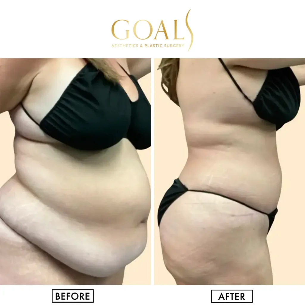 Before and after — Awake Liposuction with FlexSculpt, patient 3