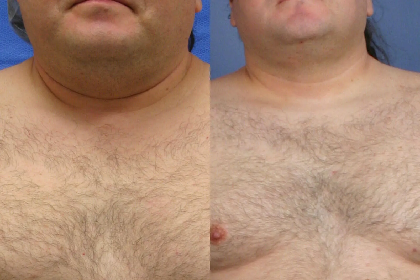 Before and after — Awake Liposuction with FlexSculpt, patient 4