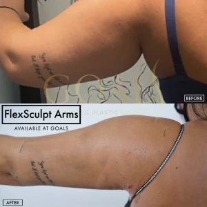 Before and after — Awake Liposuction with FlexSculpt, patient 5