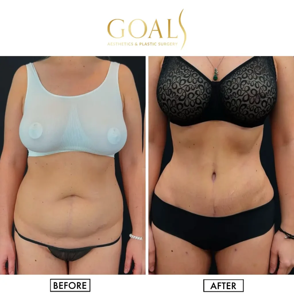Before and after — Awake Liposuction with FlexSculpt, patient 6