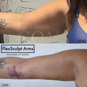Before and after — Lipoescultura Despierta con FlexSculpt · Fair Lawn, patient 1