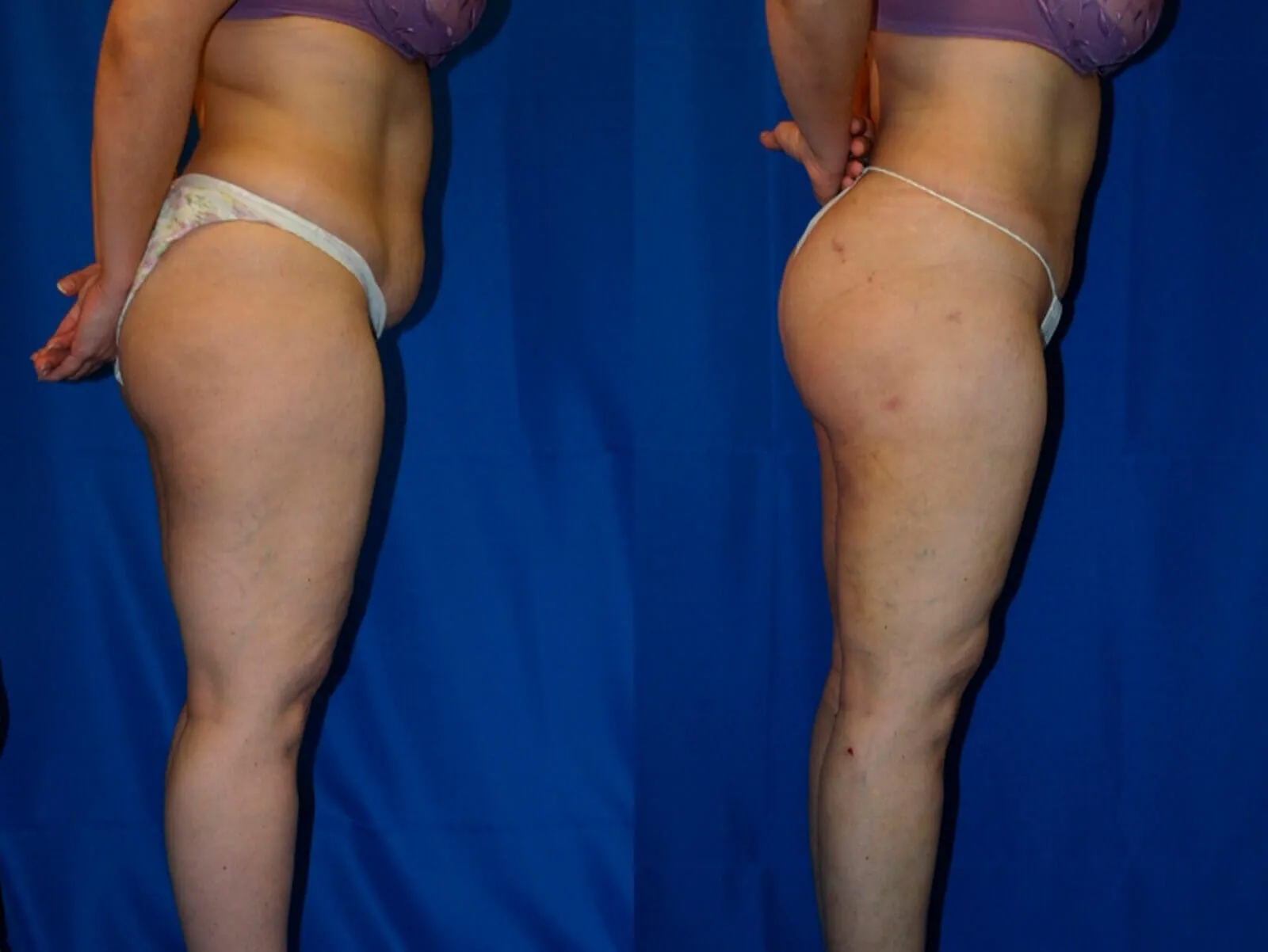 Before and after — Lipoescultura Despierta con FlexSculpt · Fair Lawn, patient 2