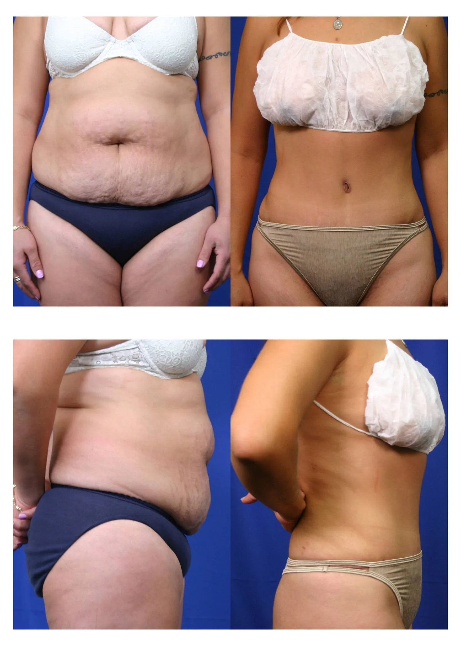 Before and after — Lipoescultura Despierta con FlexSculpt · Fair Lawn, patient 3