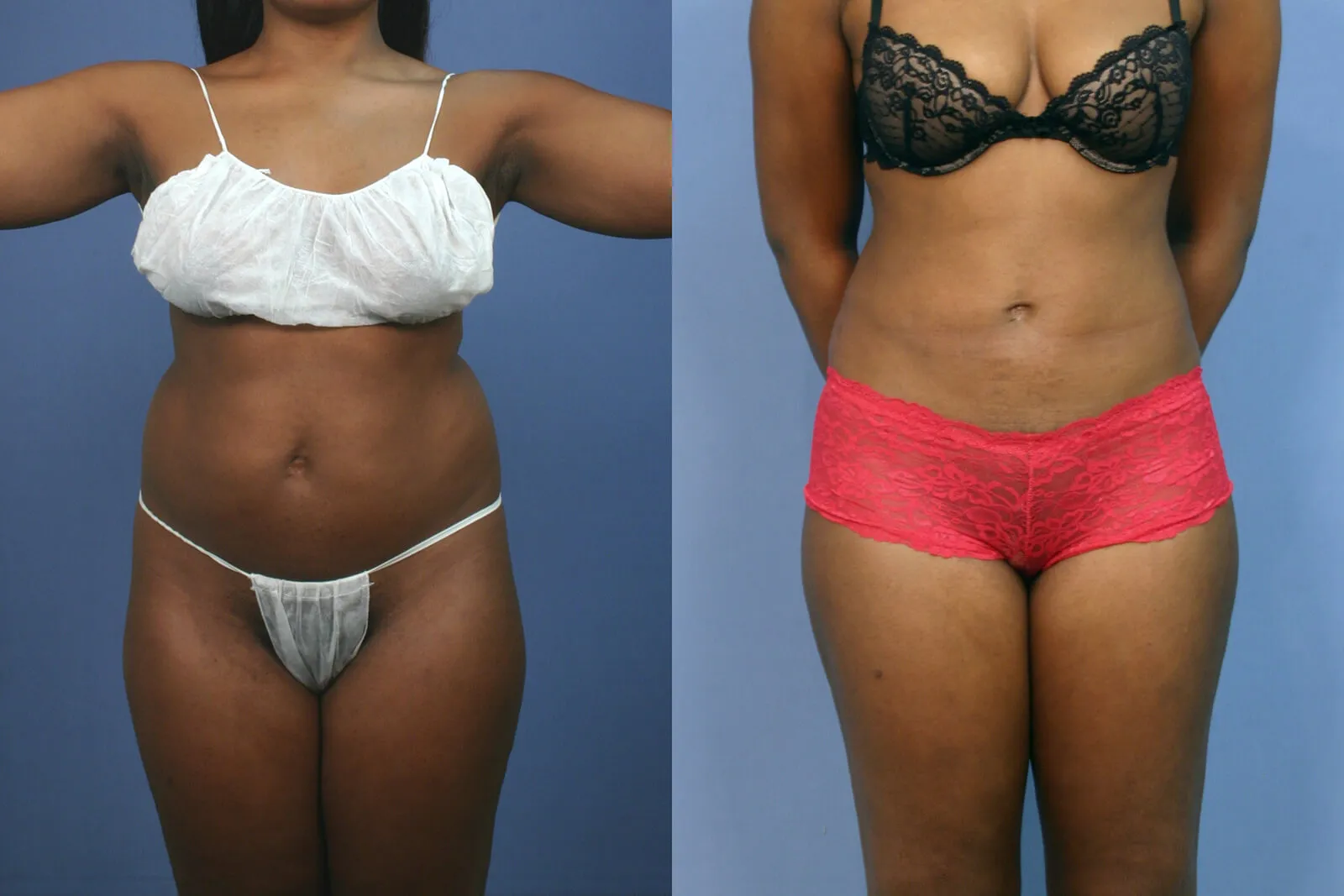 Before and after — Awake Liposuction with FlexSculpt, patient 1