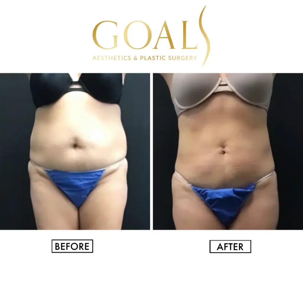 Before and after — Awake Liposuction with FlexSculpt, patient 2