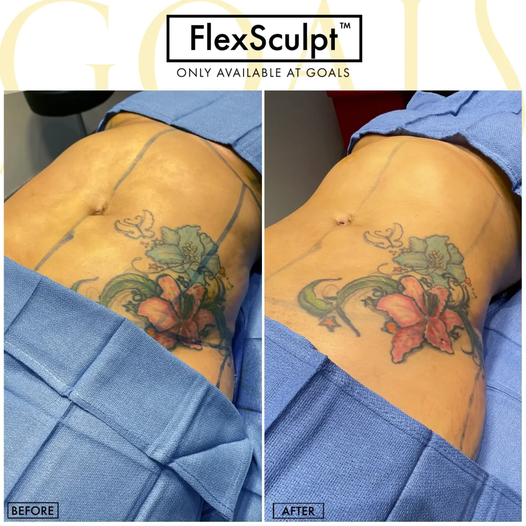 Before and after — Awake Liposuction with FlexSculpt, patient 3