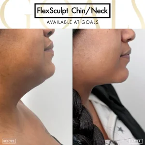 Before and after — Awake Liposuction with FlexSculpt, patient 4